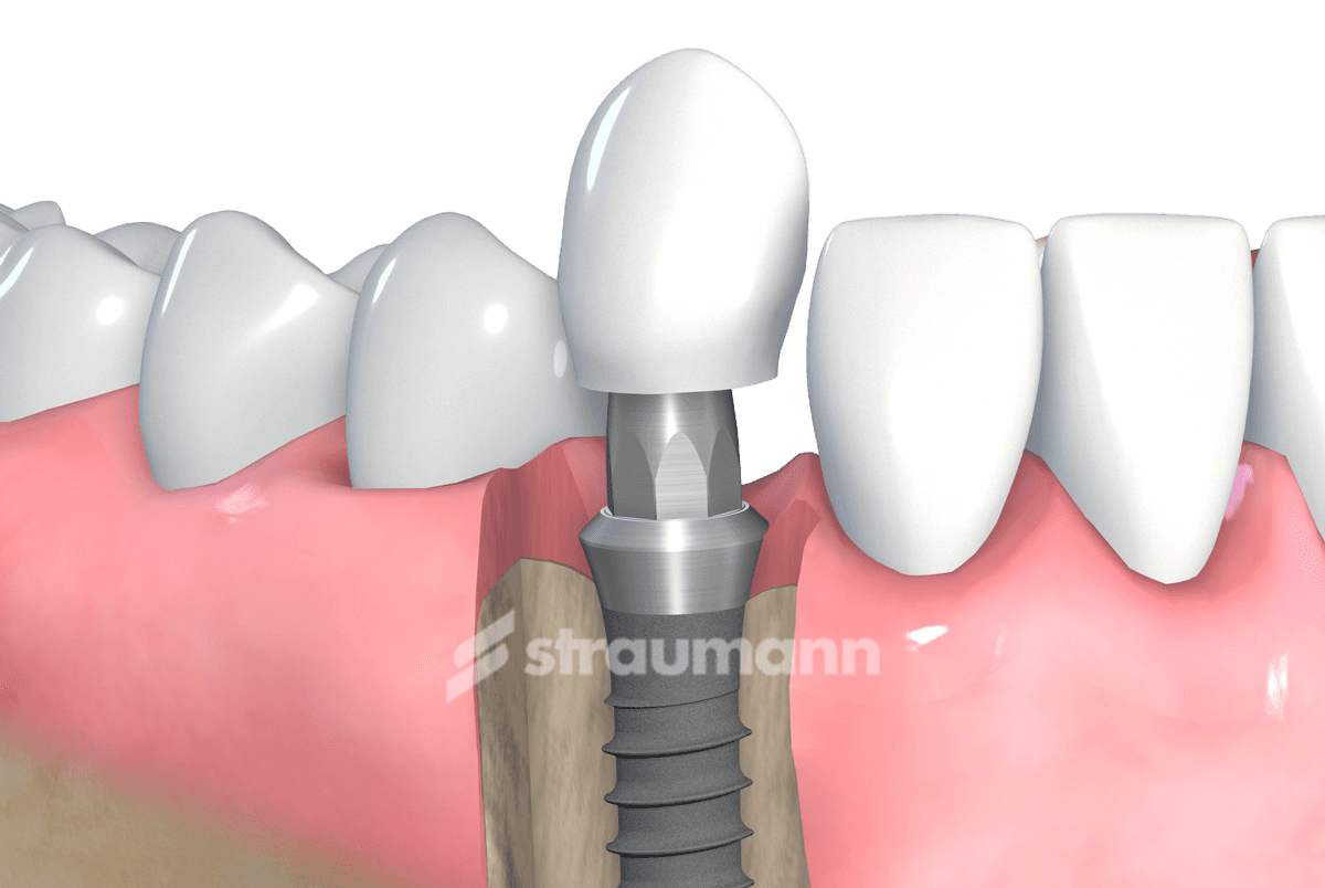 ЗУБНОЙ ИМПЛАНТ STRAUMANN