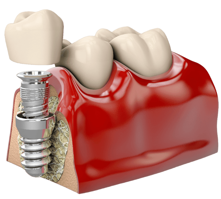 ЗУБНОЙ ИМПЛАНТ DENTIUM